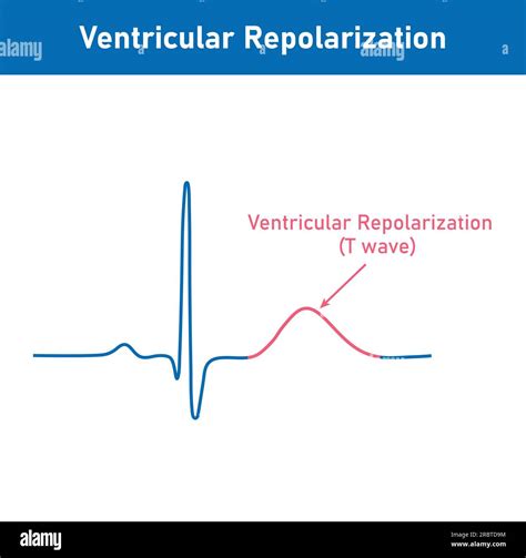 Ventricular Repolarization Is Represented By The