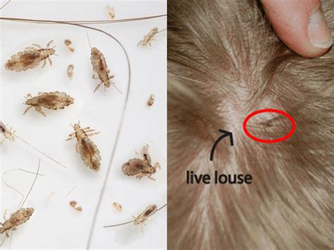 What Is The Singular For Lice